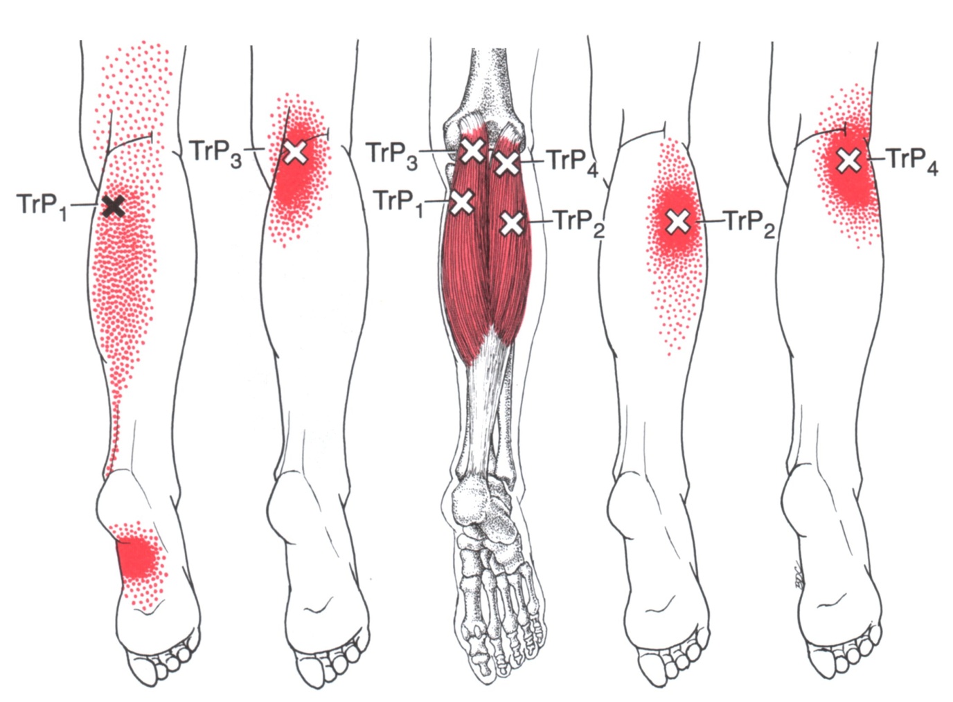 Gastrocnemius The Trigger Point Referred Pain Guide