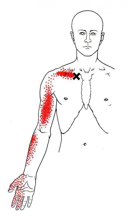 Subclavius | The Trigger Point & Referred Pain Guide